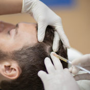 PRP capilar Barcelona — Dr. Bermejo Pérez