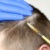 Mesoterapia capilar Barcelona — Dr. Bermejo Pérez