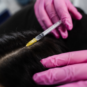 Exosomas capilares Barcelona — Dr. Bermejo Pérez