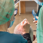 Micropigmentación capilar SMP Barcelona — Dr. Bermejo Pérez