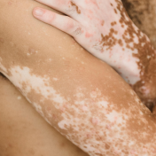 Micropigmentación vitiligo Barcelona — Dr. Bermejo Pérez