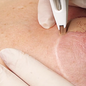 Micropigmentación de cicatrices Barcelona — Dr. Bermejo Pérez
