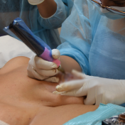 Micropigmentación de areola Barcelona — Dr. Bermejo Pérez