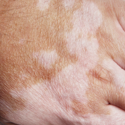 Micropigmentación vitiligo genital Barcelona — Dr. Bermejo Pérez