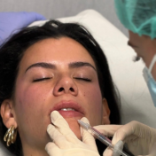 Relleno de labios Barcelona — Dr. Bermejo Pérez
